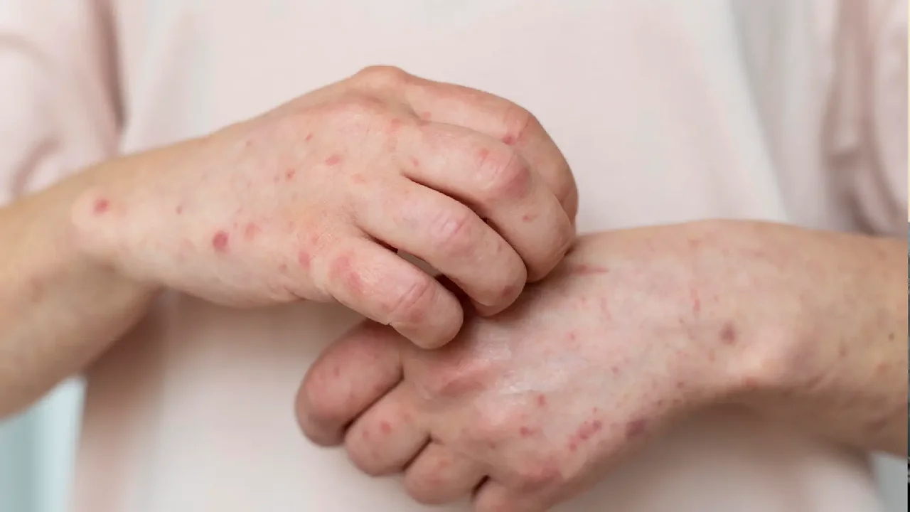 Bogotá Activates Emergency Plan After Confirming Three Cases of Measles Imported from Mexico