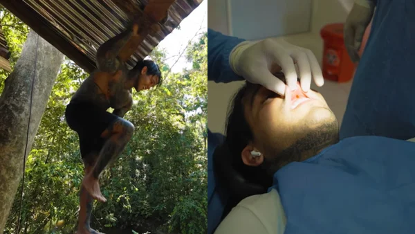 Yeferson Cossio sufrió accidente y tuvo que ser intervenido de urgencia