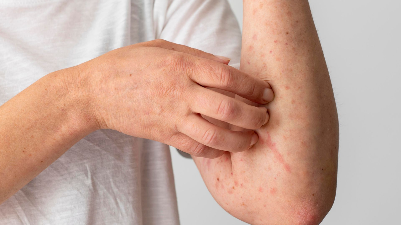 Alert over the increase in chickenpox cases in Colombia: nearly 6,000 reports in 2026