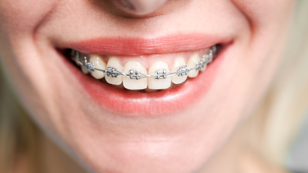 Invima gives recommendations for the safe use of orthodontic devices