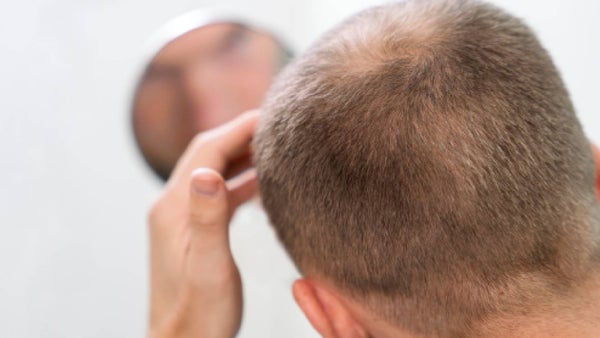Alopecia en Colombia: Causas, tratamientos y auge del trasplante capilar