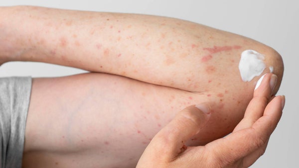 Confirman quinto caso importado de sarampión y advierten riesgo de brote: ¿de dónde llegó?