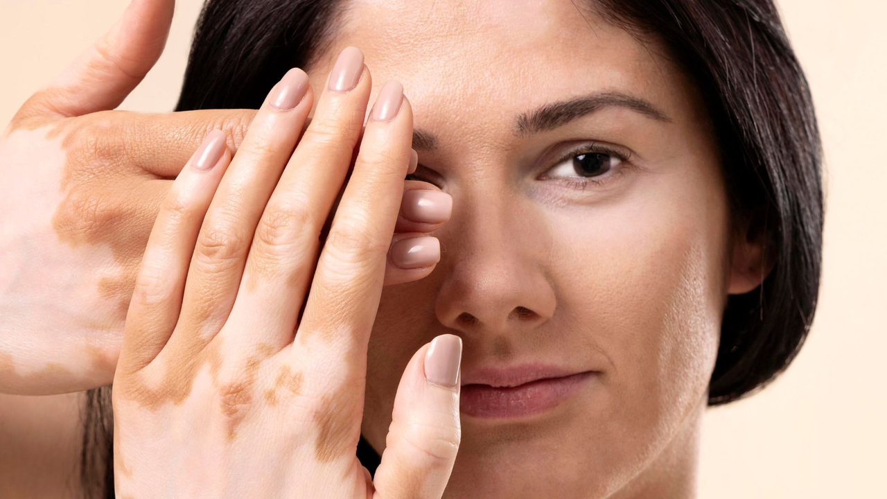 What causes vitiligo, the skin disease Michael Jackson had?