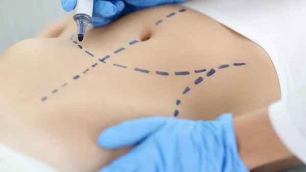Los pilares de seguridad para tener en cuenta antes de practicarse una liposucción Los pilares de seguridad para tener en cuenta antes de practicarse una liposucción