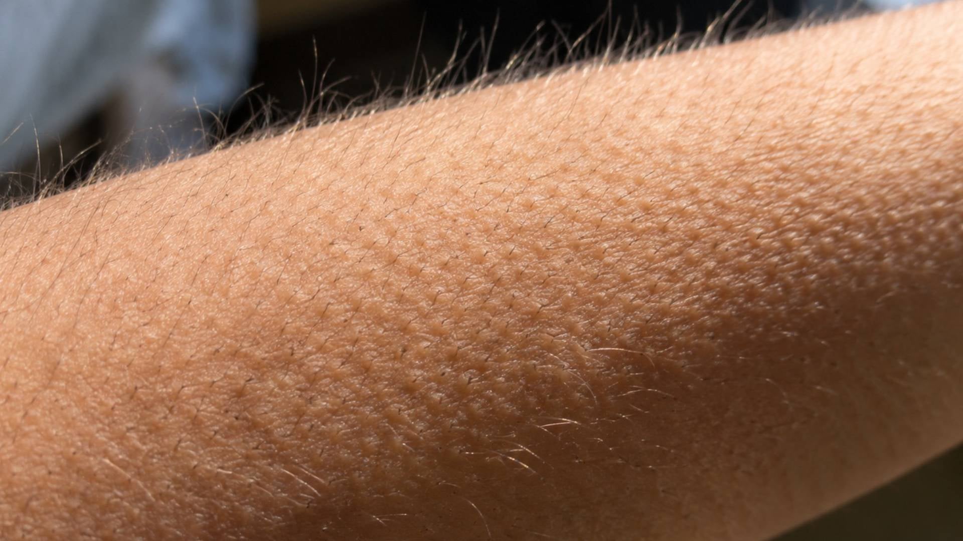 Piel de gallina
